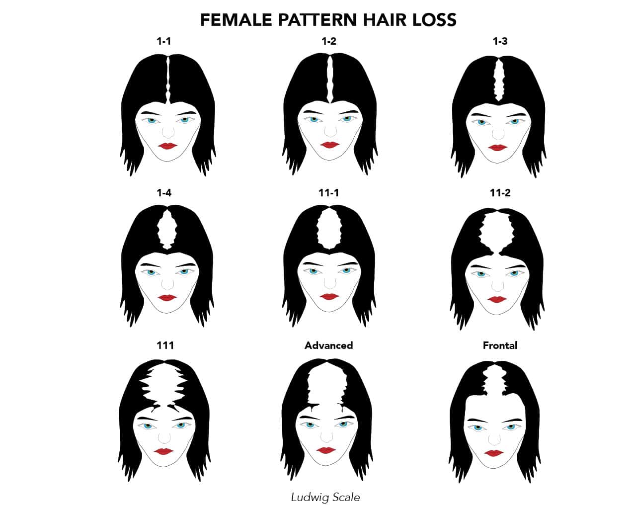 Female-hair-loss-ludwig-scale