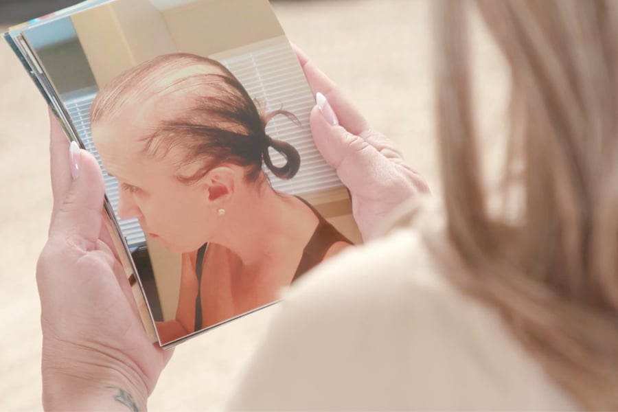 Mirnas-hair-loss-photos