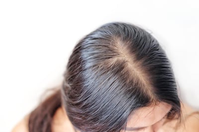 female-pattern-hair-loss