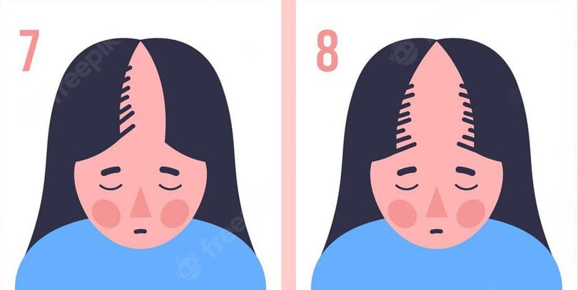 finall-stages-female-hairloss