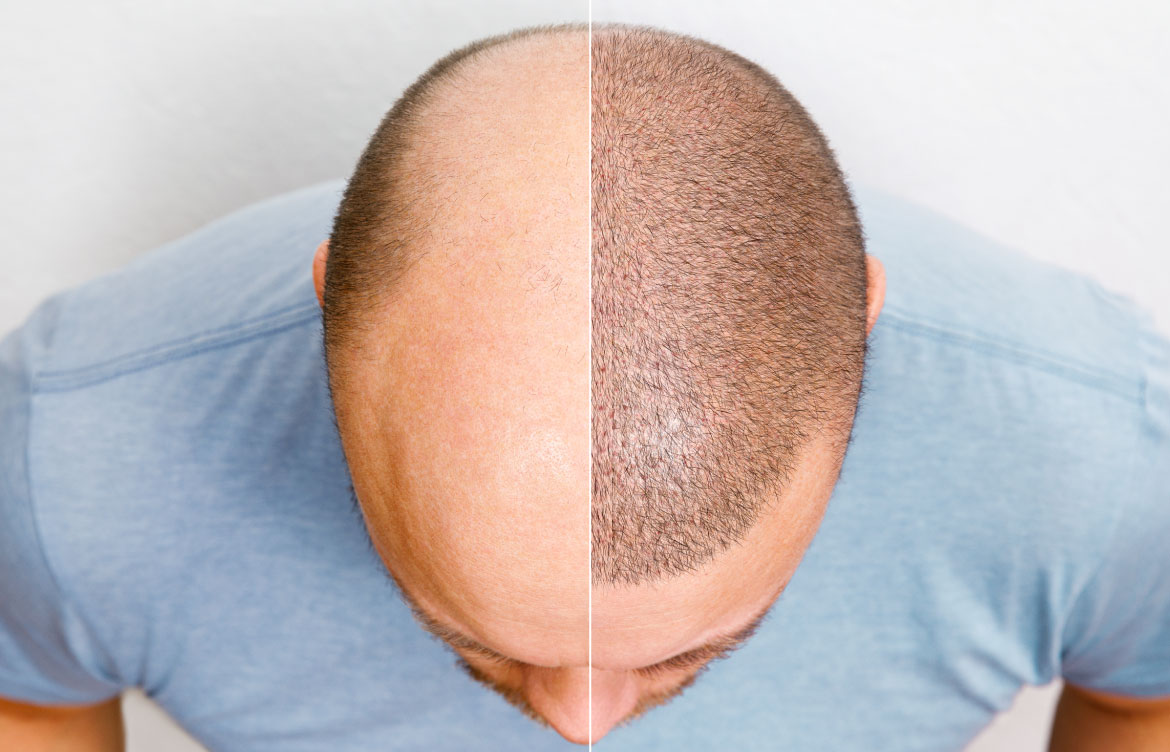 Genetic Hair Loss Treatment How To Treat Hereditary Hair Loss