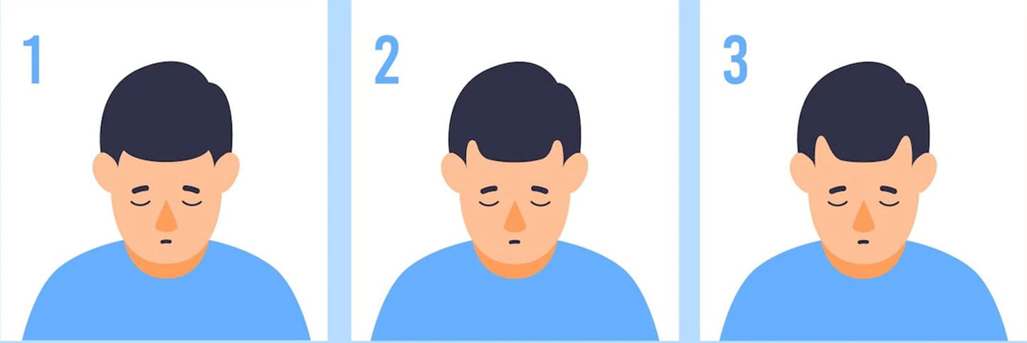 male-early-stage-hair-loss