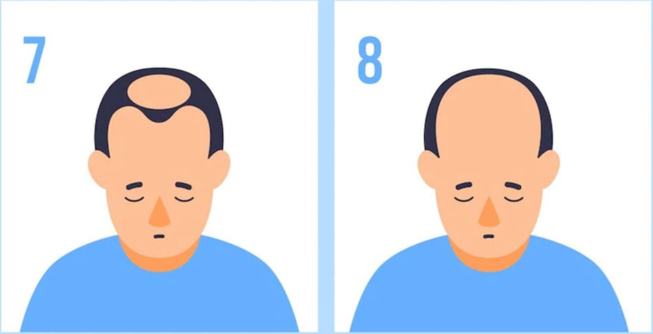male-final-pattern-hair-loss-stage