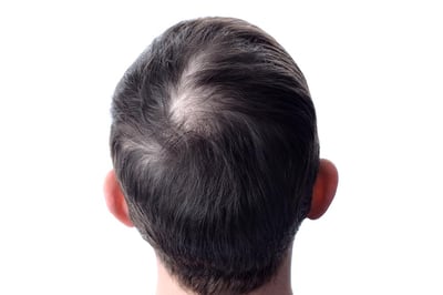 male-pattern-hair-loss