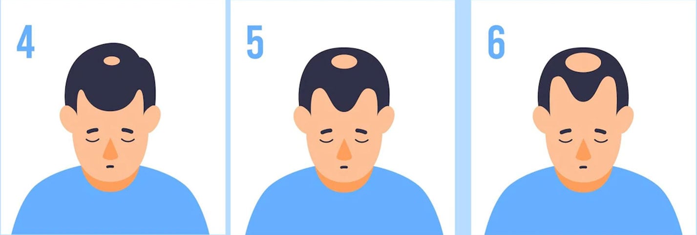 middle-male-hair-loss-tage