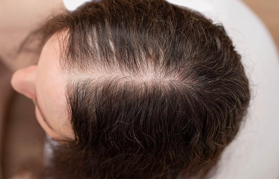 thin-head-of-hair-from-top