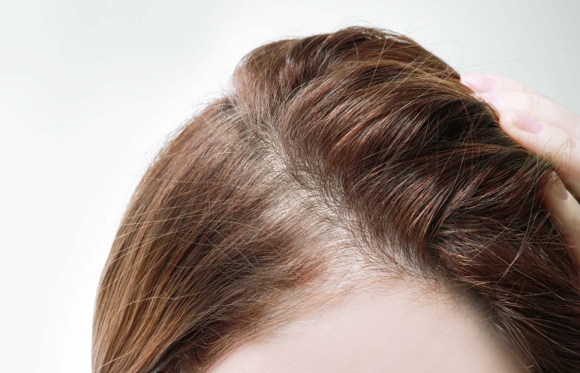 traction-alopecia-treatment-1170x752