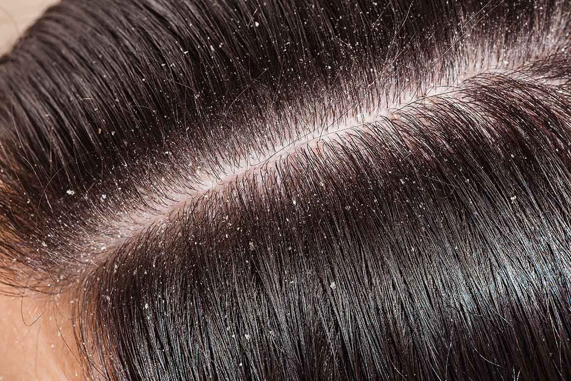 How to Treat a Dry Scalp - Best Dry Scalp Treatments, Remedies & Tips