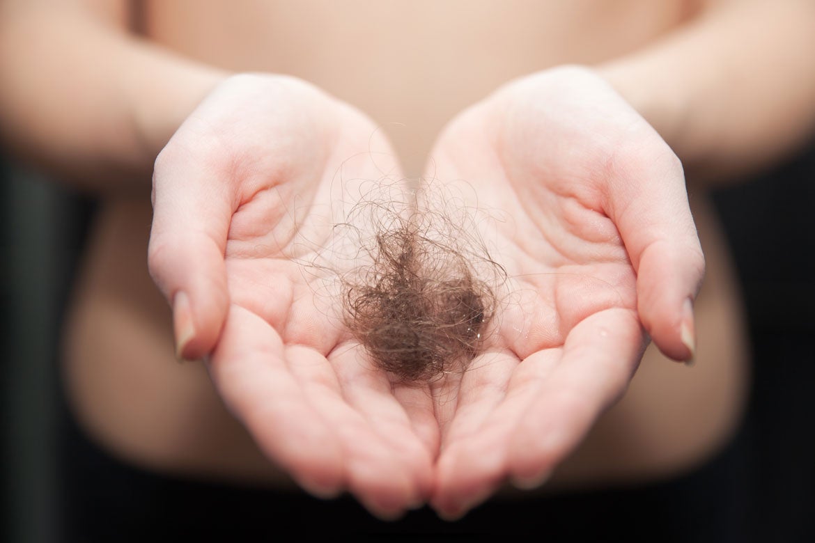 27% of COVID patients had significant increases in hair loss during recovery