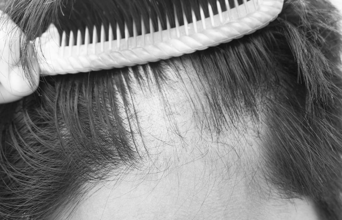 What are the Signs & Symptoms of Alopecia Hair Loss?